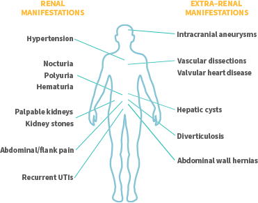 Renal and Extra-Renal Manifestations in Patients with ADPKD